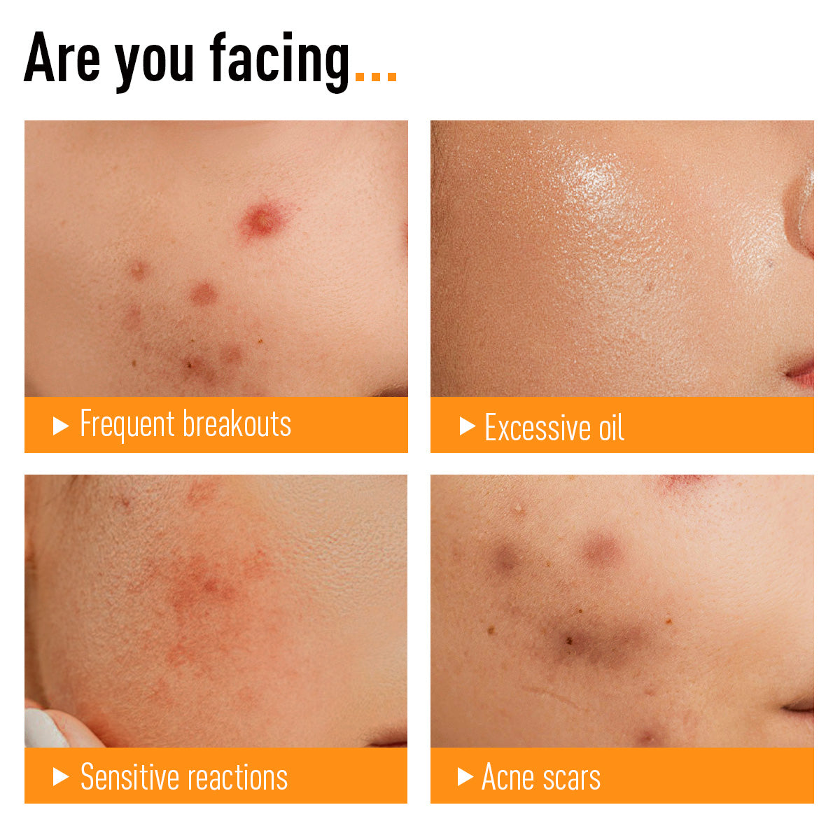5D ULTIMATE ACNE SOLUTION